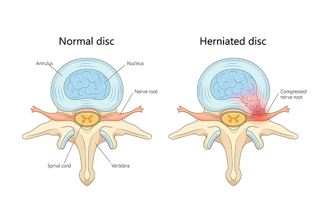 Real Solutions for Back Pain Caused by Herniated Discs